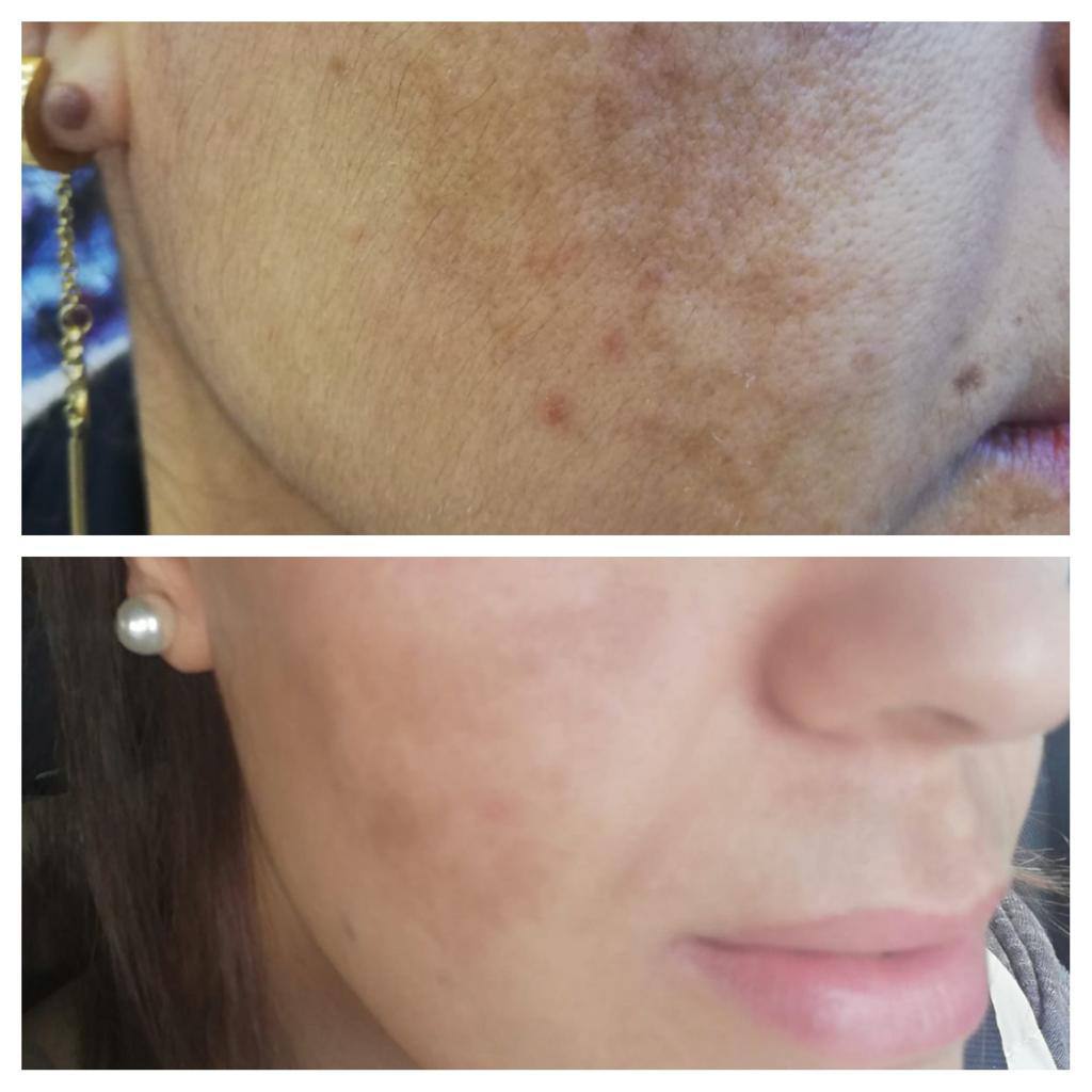 Leke Tedavisi - Alanya Estetik ve Güzellik Merkezi Dermalanya