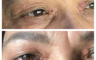 göz kapağı estetiği